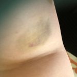 morado en brazo tras analítica